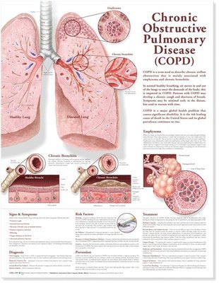 bokomslag Chronic Obstructive Pulmonary Disease Anatomical Chart