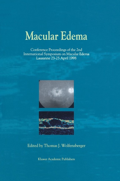 bokomslag Macular Edema