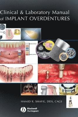 bokomslag Clinical and Laboratory Manual of Implant Overdentures