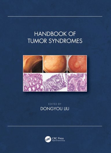 Dongyou Liu - Handbook of Tumor Syndromes, Inbunden