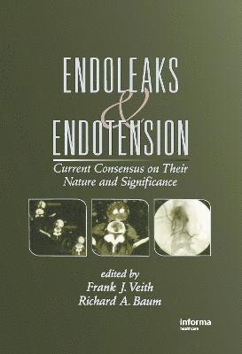 Endoleaks and Endotension 1