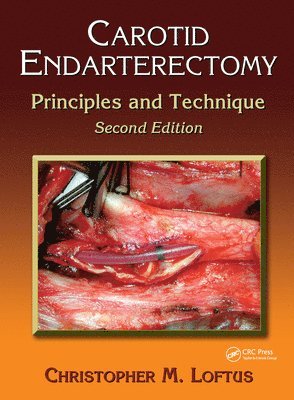 Carotid Endarterectomy 1