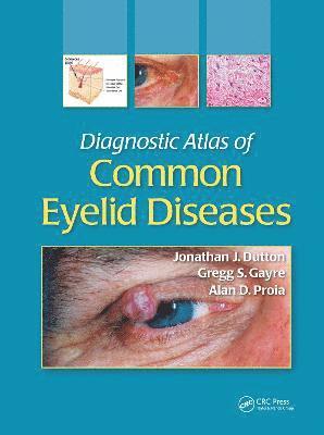 Jonathan J. Dutton, Gregg S. Gayre, Alan D. Proia, USA) Dutton, Jonathan J. (University of North Carolina at Chapel Hill, USA) Gayre, Gregg S. (Atlantic Eye and Face Center, Cary, North Carolina, USA) Proia, Alan D. (Duke University Eye Center, Durham, NC - Diagnostic Atlas of Common Eyelid Diseases, Inbunden