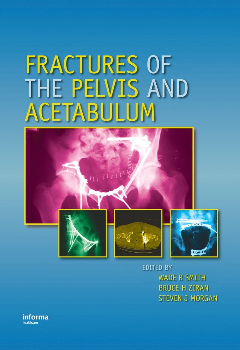 Wade R. Smith, Bruce H. Ziran, Steven J Morgan, USA) Smith, Wade R. (Denver Health Medical Center, Colorado, USA) Ziran, Bruce H. (St. Elizabeth Health Center, Youngstown, Ohio, USA) Morgan, Steven J (Denver Health Medical Center, Colorado - Fractures of the Pelvis and Acetabulum, Inbunden