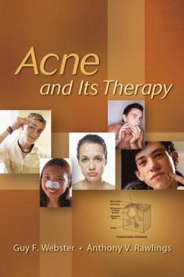 Acne and Its Therapy 1