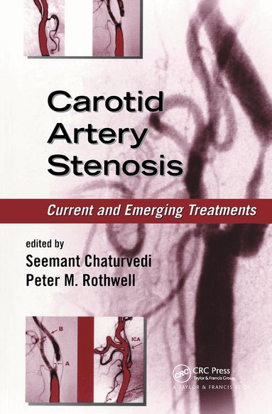 Seemant Chaturvedi, Peter M. Rothwell - Carotid Artery Stenosis, Inbunden