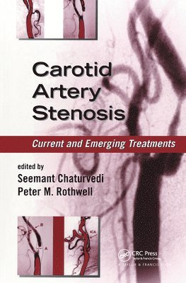 Carotid Artery Stenosis 1