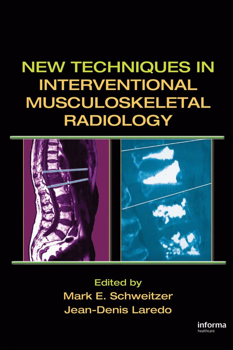 Mark E. Schweitzer, Jean-Denis Laredo, USA) Schweitzer, Mark E. (Hospital for Joint Diseases, New York, New York, France) Laredo, Jean-Denis (Hopital Lariboisiere, Paris - New Techniques in Interventional Musculoskeletal Radiology, Inbunden