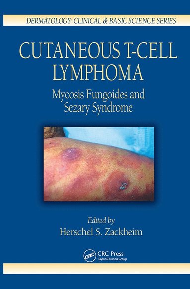 bokomslag Cutaneous T-Cell Lymphoma