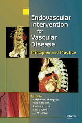 Matt M. Thompson, Robert A. Morgan, Jon S. Matsumura, Marc Sapoval, Ian M. Loftus - Endovascular Intervention for Vascular Disease, Inbunden