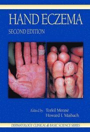 bokomslag Hand Eczema