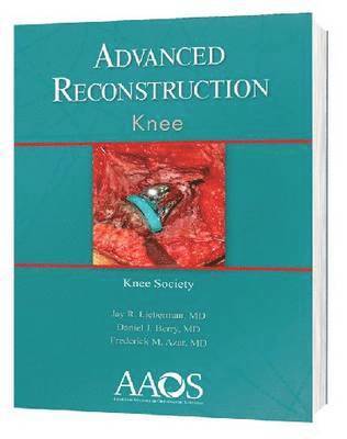 Advanced Reconstruction: Knee
