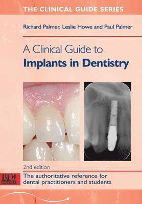 Clinical Guide to Implants in Dentistry