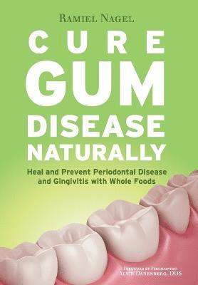 Cure Gum Disease Naturally 1