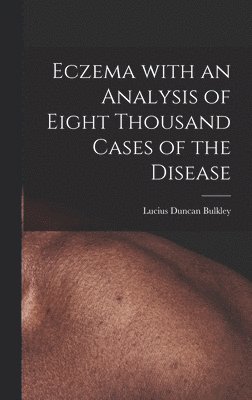 bokomslag Eczema With an Analysis of Eight Thousand Cases of the Disease