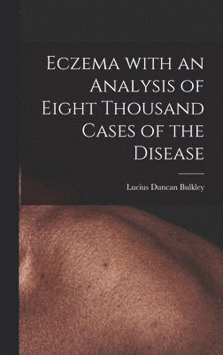 Eczema With an Analysis of Eight Thousand Cases of the Disease 1