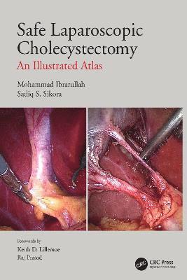 Safe Laparoscopic Cholecystectomy 1