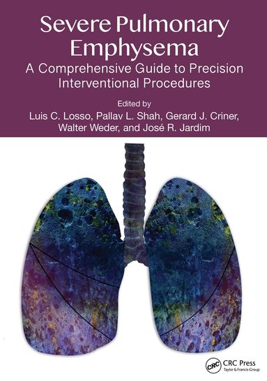 Luis C. Losso, Pallav L. Shah, Gerald J. Criner, Walter Weder, José R Jardim - Severe Pulmonary Emphysema:, Inbunden