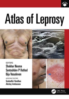 bokomslag Atlas of Leprosy