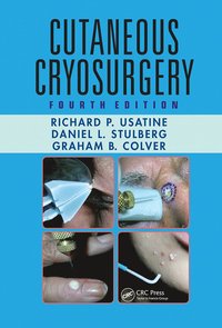 bokomslag Cutaneous Cryosurgery