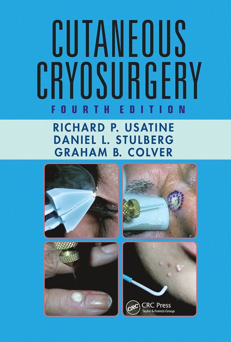 Richard P. Usatine, Daniel L. Stulberg, Graham B. Colver, Richard P Usatine, Daniel L Stulberg, Graham B Colver - Cutaneous Cryosurgery, Häftad