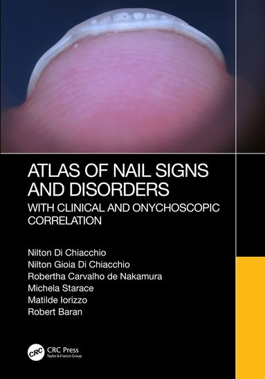 Nilton Di Chiacchio, Nilton Gioia Di Chiacchio, Robertha Carvalho de Nakamura, Michela Starace, Matilde Iorizzo, Robert Baran - Atlas of Nail Signs and Disorders with Clinical and Onychoscopic Correlation, Inbunden