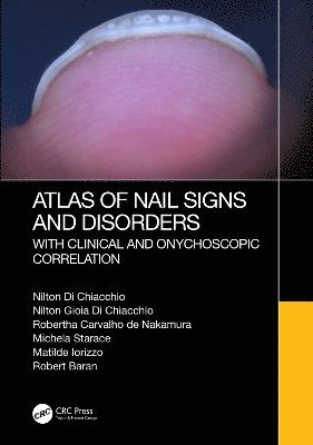 Atlas of Nail Signs and Disorders with Clinical and Onychoscopic Correlation 1