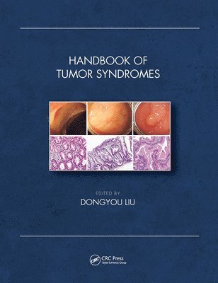 Dongyou Liu, Australia) Liu, Dongyou (Royal College of Pathologists of Australasia, St. Leonards, New South Wales - Handbook of Tumor Syndromes, Häftad