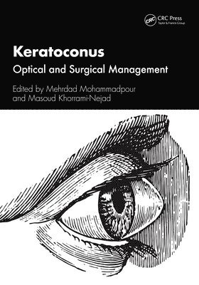 Keratoconus 1