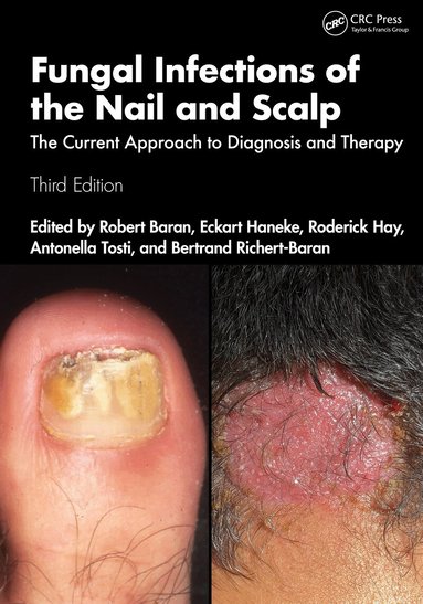 Robert Baran, Eckart Haneke, Roderick Hay, Antonella Tosti, Bertrand Richert-Baran - Fungal Infections of the Nail and Scalp, Häftad