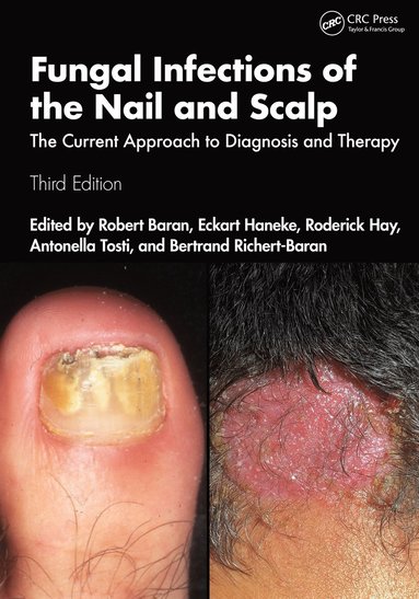 bokomslag Fungal Infections of the Nail and Scalp