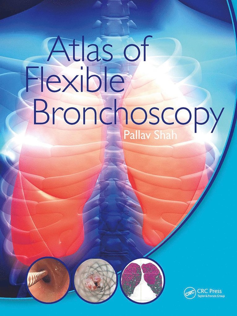 Pallav Shah, UK) Shah, Pallav (MD FRCP Consultant Physician and Honorary Senior Lecturer, Royal Brompton Hospital, Chelsea and Westminster Hospital and Imperial College London - Atlas of Flexible Bronchoscopy, Häftad