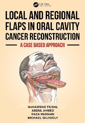 Local and Regional Flaps in Oral Cavity Cancer Reconstruction 1