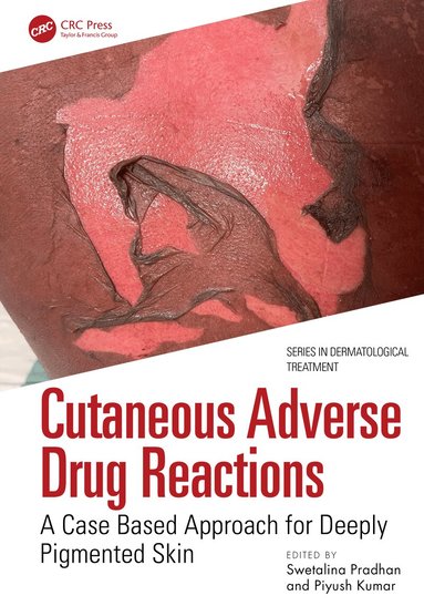 Swetalina Pradhan, Piyush Kumar - Cutaneous Adverse Drug Reactions, Häftad