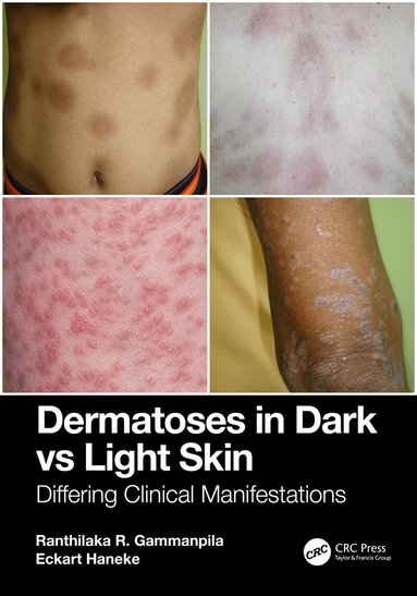 Ranthilaka R. Gammanpila, Eckart Haneke - Dermatoses in Dark Vs Light Skin, Häftad
