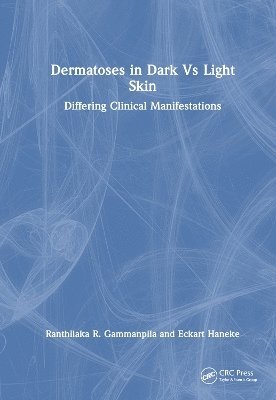 Dermatoses in Dark Vs Light Skin 1