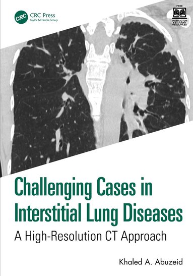 Khaled A. Abuzeid - Challenging Cases in Interstitial Lung Diseases, Häftad