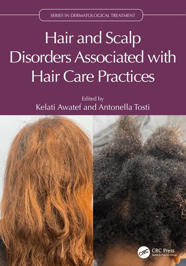 Kelati Awatef, Antonella Tosti - Hair and Scalp Disorders Associated with Hair Care Practices, Häftad