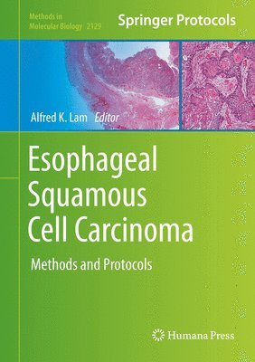Alfred K. Lam - Esophageal Squamous Cell Carcinoma, Inbunden