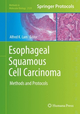 Esophageal Squamous Cell Carcinoma 1