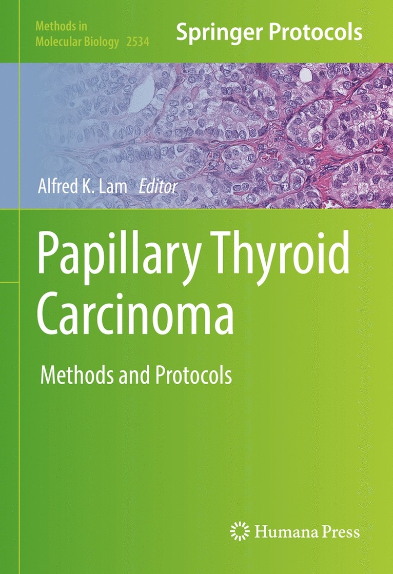 Alfred K. Lam - Papillary Thyroid Carcinoma, Inbunden