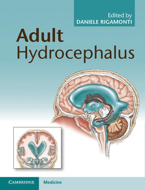 Adult Hydrocephalus 1