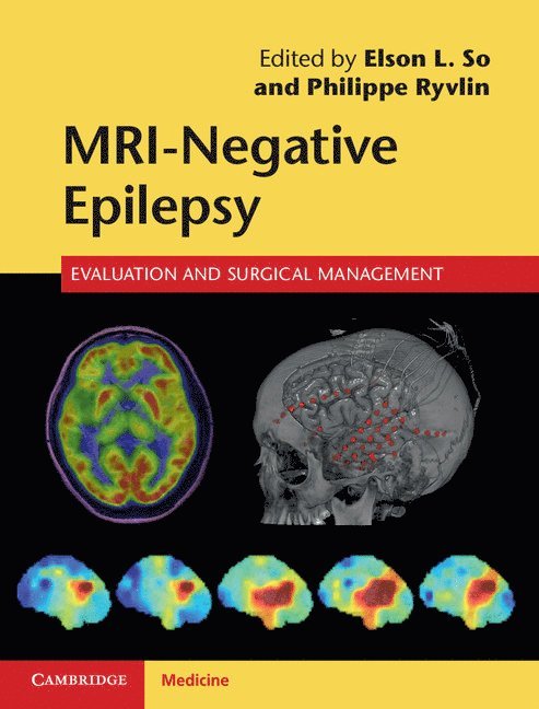 Elson L. So, Philippe Ryvlin - MRI-Negative Epilepsy, Inbunden