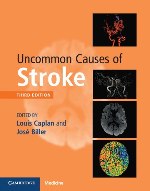 Uncommon Causes of Stroke 1