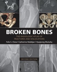 bokomslag Broken Bones