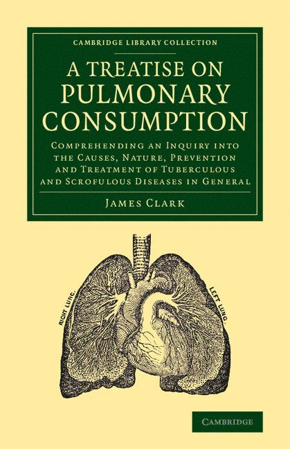 A Treatise on Pulmonary Consumption 1