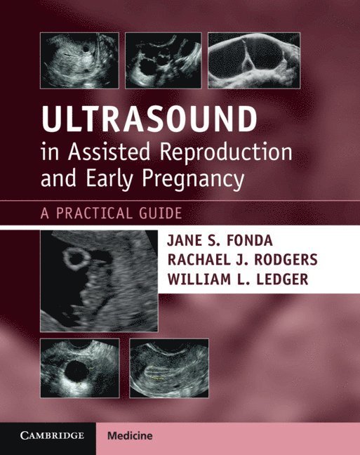 Ultrasound in Assisted Reproduction and Early Pregnancy 1