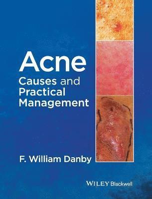 bokomslag Acne