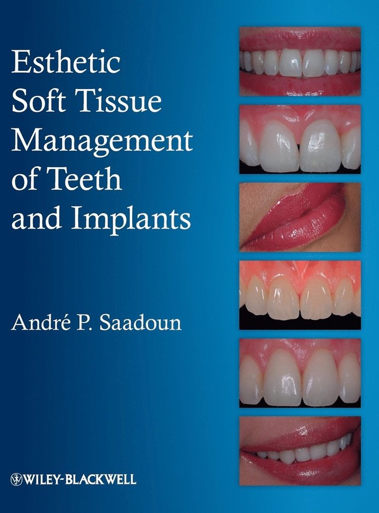 Andre P. Saadoun, Saadoun, Andre P Saadoun - Esthetic Soft Tissue Management of Teeth and Implants, Inbunden