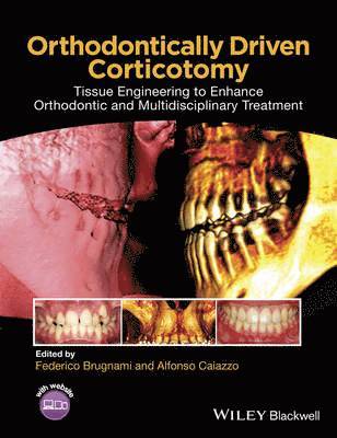 Orthodontically Driven Corticotomy 1